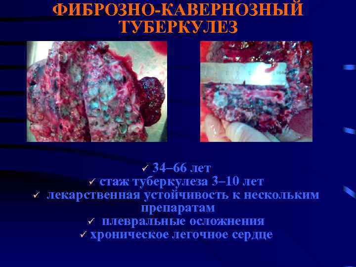 ФИБРОЗНО-КАВЕРНОЗНЫЙ ТУБЕРКУЛЕЗ ü 34– 66 лет ü стаж туберкулеза 3– 10 лет ü лекарственная