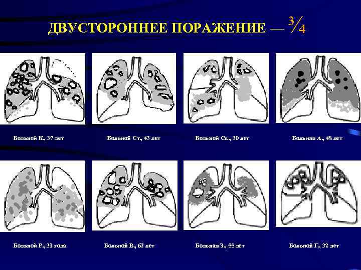 ¾ ДВУСТОРОННЕЕ ПОРАЖЕНИЕ — Больной К. , 37 лет Больной Р. , 31 года