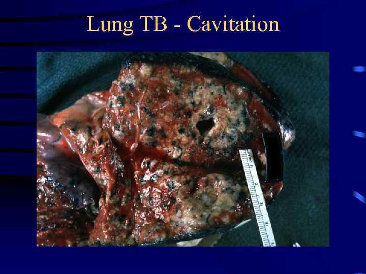 Lung TB - Cavitation 