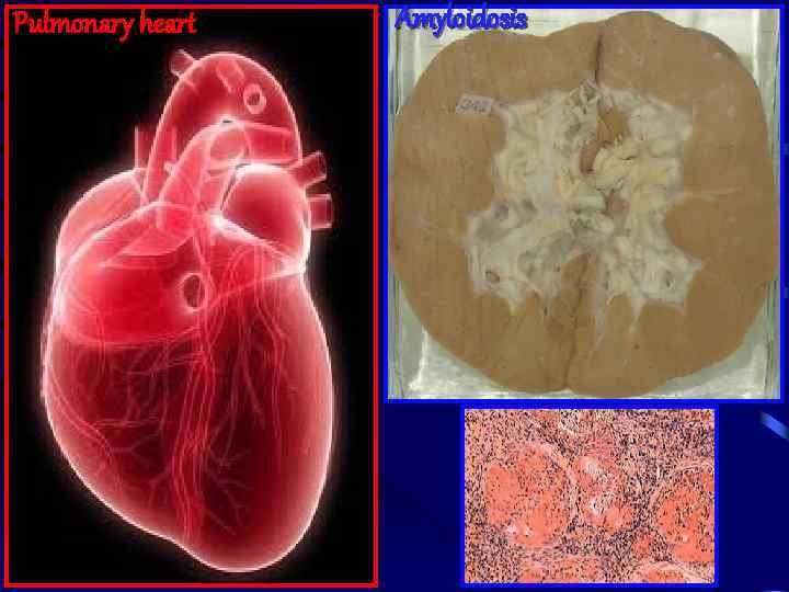 Pulmonary heart Amyloidosis 