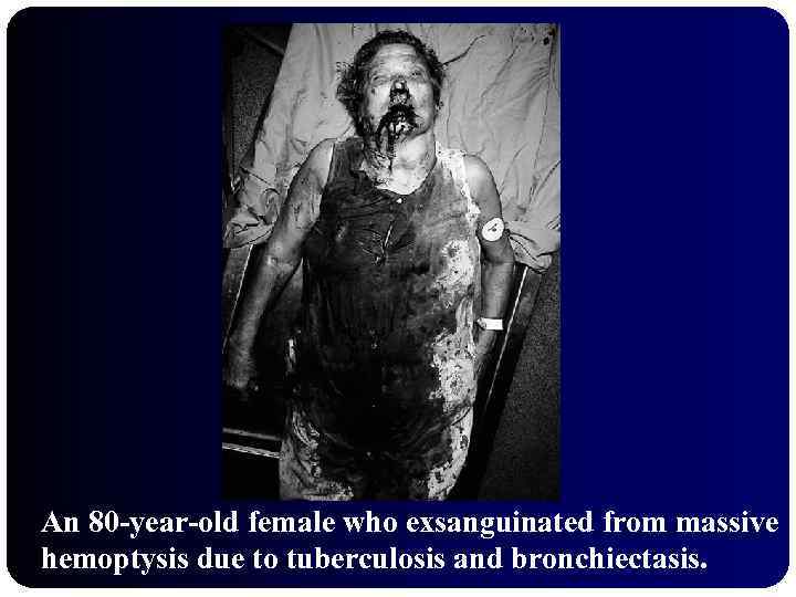 An 80 -year-old female who exsanguinated from massive hemoptysis due to tuberculosis and bronchiectasis.