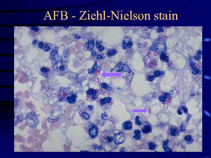 AFB - Ziehl-Nielson stain 