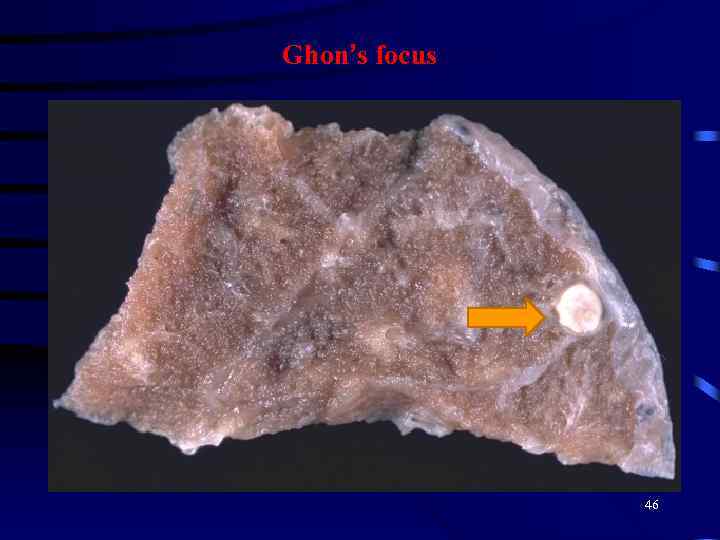 Ghon’s focus 46 