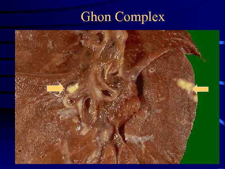 Ghon Complex 