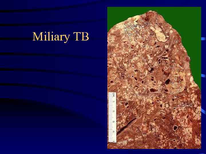 Miliary TB 