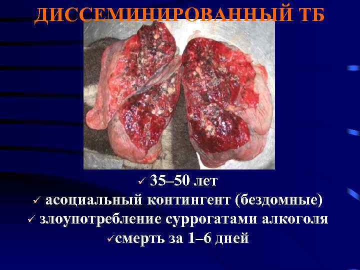 ДИССЕМИНИРОВАННЫЙ ТБ ü 35– 50 лет ü асоциальный контингент (бездомные) ü злоупотребление суррогатами алкоголя