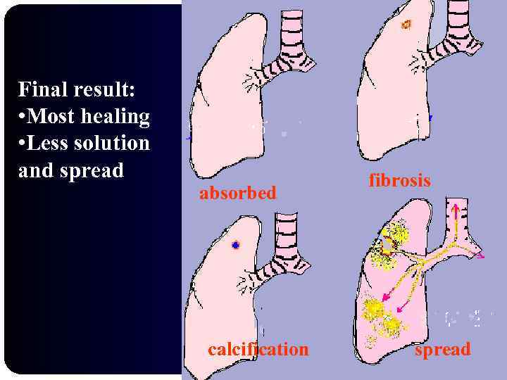 Final result: • Most healing • Less solution and spread absorbed calcification fibrosis spread