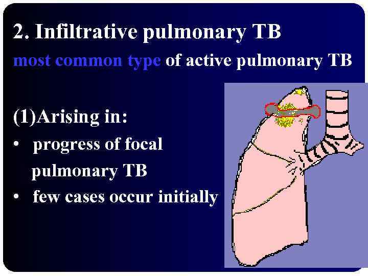 2. Infiltrative pulmonary TB most common type of active pulmonary TB (1)Arising in: •