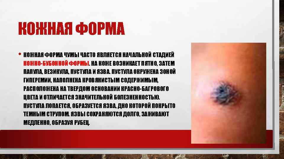 КОЖНАЯ ФОРМА • КОЖНАЯ ФОРМА ЧУМЫ ЧАСТО ЯВЛЯЕТСЯ НАЧАЛЬНОЙ СТАДИЕЙ КОЖНО-БУБОННОЙ ФОРМЫ. НА КОЖЕ