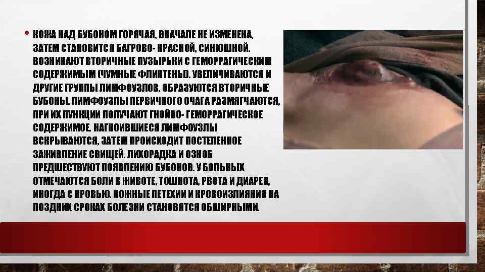  • КОЖА НАД БУБОНОМ ГОРЯЧАЯ, ВНАЧАЛЕ НЕ ИЗМЕНЕНА, ЗАТЕМ СТАНОВИТСЯ БАГРОВО- КРАСНОЙ, СИНЮШНОЙ.