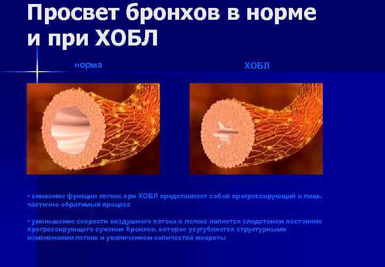 Просвет бронхов в норме и при ХОБЛ норма ХОБЛ • снижение функции легких при