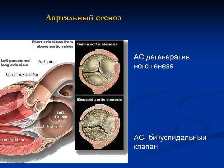 Аортальный стеноз АС дегенератив ного генеза АС- бикуспидальный клапан 