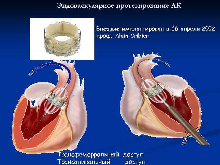 Эндоваскулярное протезирование АК Впервые имплантирован в 16 апреля 2002 проф. Alain Cribier Трансфеморральный Трансапикальный