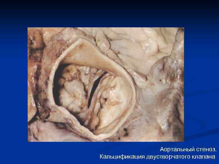 Аортальный стеноз. Кальцификация двустворчатого клапана. 