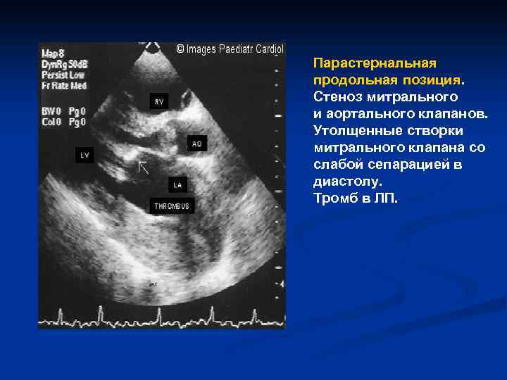 Парастернальная продольная позиция. Стеноз митрального и аортального клапанов. Утолщенные створки митрального клапана со слабой