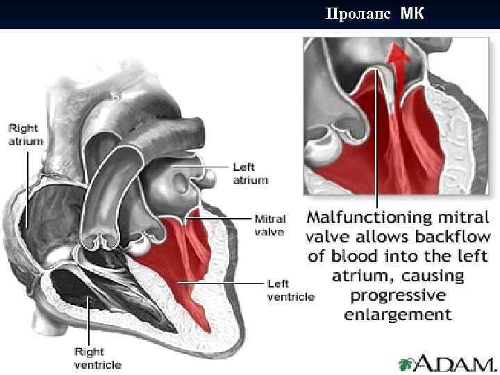  Пролапс МК 