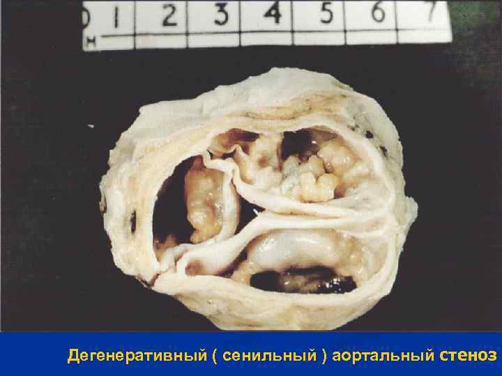 Дегенеративный ( сенильный ) аортальный стеноз 