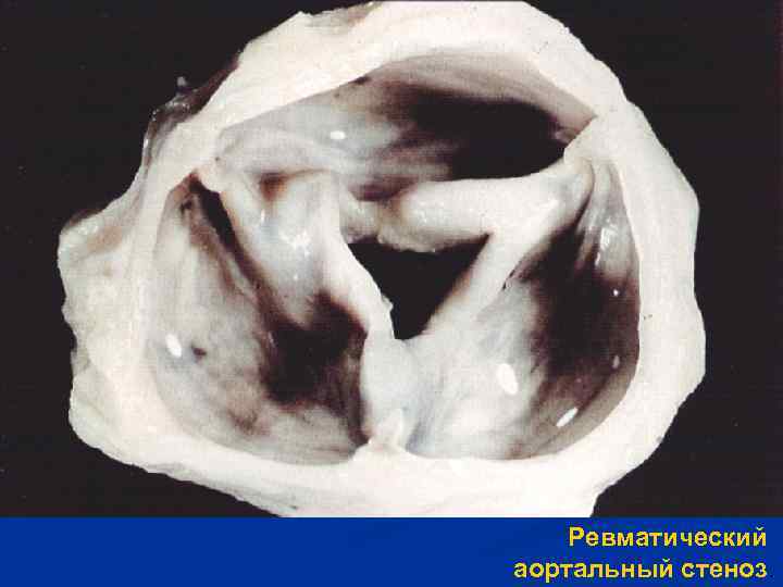 Ревматический аортальный стеноз. 