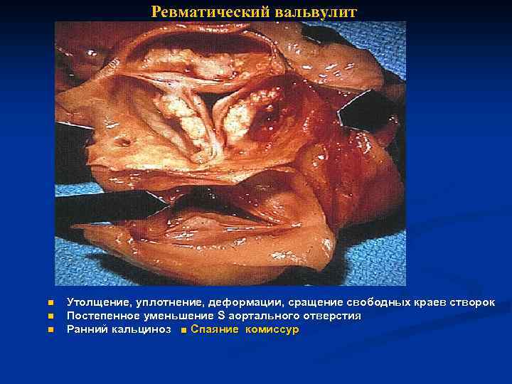 Ревматический вальвулит n n n Утолщение, уплотнение, деформации, сращение свободных краев створок Постепенное уменьшение