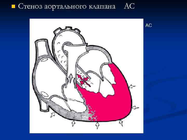 n Стеноз аортального клапана АС АС 