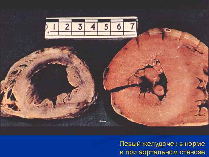 Левый желудочек в норме и при аортальном стенозе. 