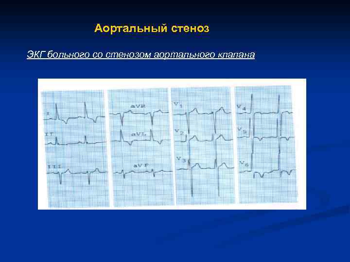  Аортальный стеноз ЭКГ больного со стенозом аортального клапана 