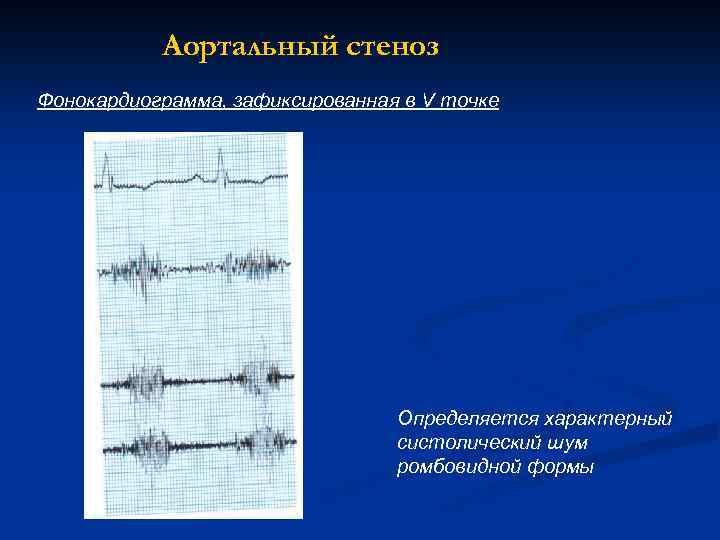  Аортальный стеноз Фонокардиограмма, зафиксированная в V точке Определяется характерный систолический шум ромбовидной формы