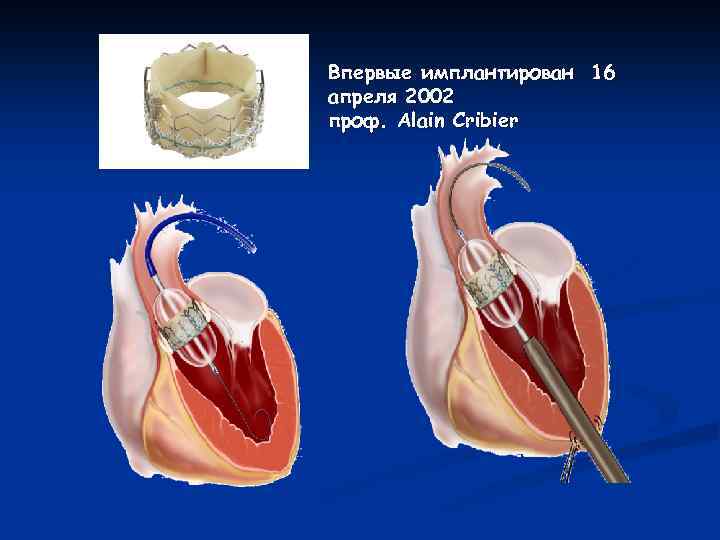 Впервые имплантирован 16 апреля 2002 проф. Alain Cribier 