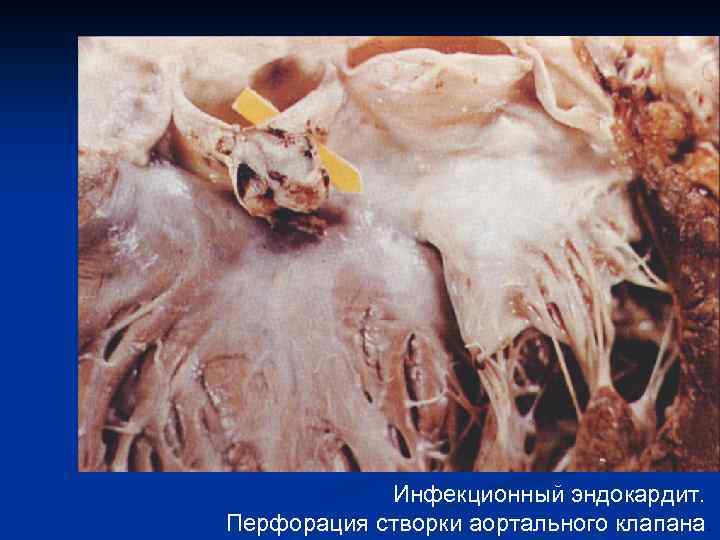 Инфекционный эндокардит. Перфорация створки аортального клапана. 