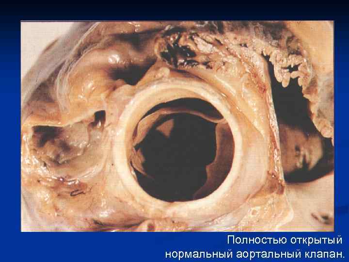 Полностью открытый нормальный аортальный клапан. 