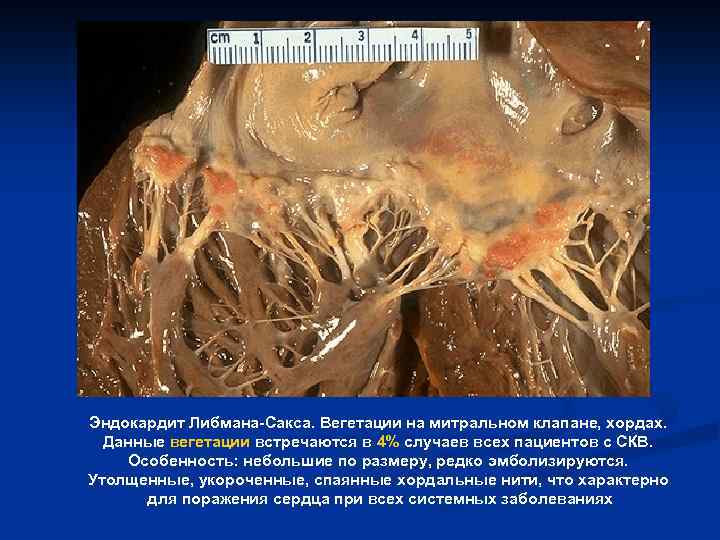 Эндокардит Либмана-Сакса. Вегетации на митральном клапане, хордах. Данные вегетации встречаются в 4% случаев всех