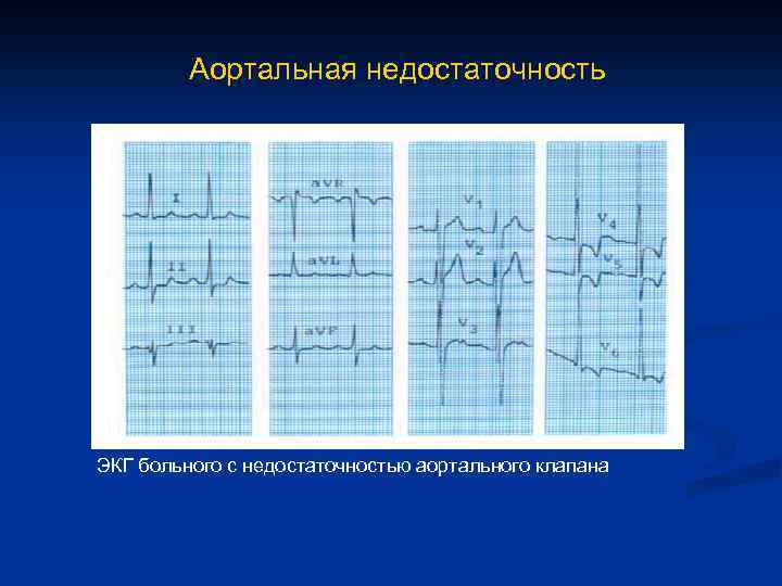 Аортальная недостаточность ЭКГ больного с недостаточностью аортального клапана 