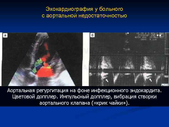 Эхокардиография у больного с аортальной недостаточностью Аортальная регургитация на фоне инфекционного эндокардита. Цветовой допплер.