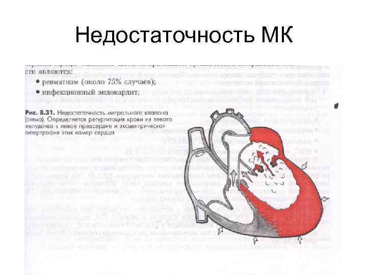 Недостаточность МК 