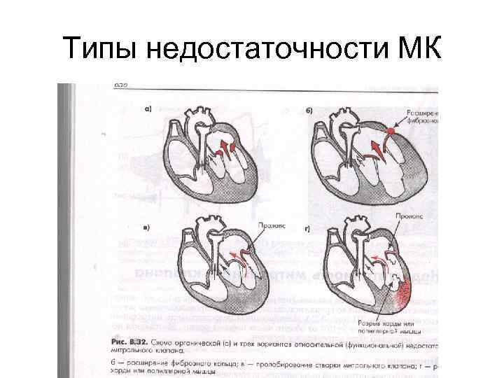 Врожденные и приобретенные пороки сердца презентация