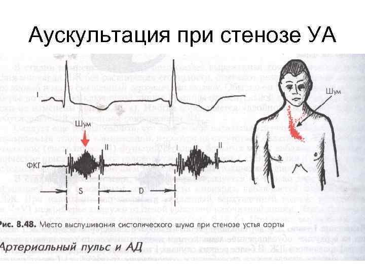 Машинный шум при аускультации