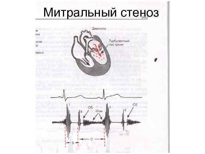 Митральный стеноз 