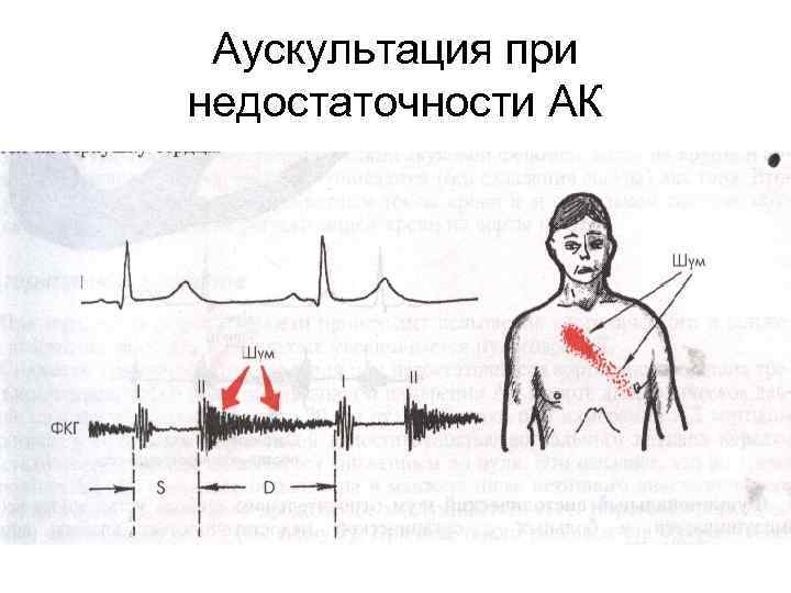 Аускультация при недостаточности АК 