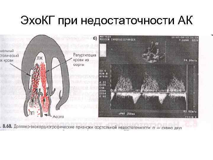 Эхо. КГ при недостаточности АК 