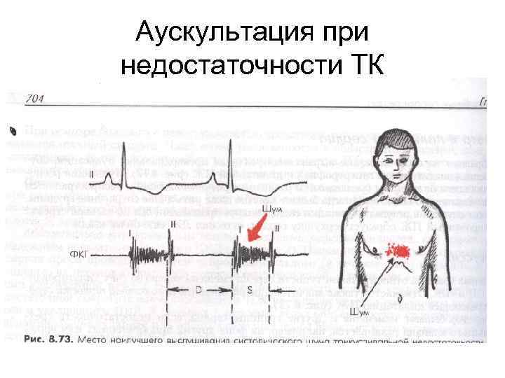 Аускультация при недостаточности ТК 