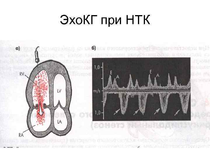 Эхо. КГ при НТК 