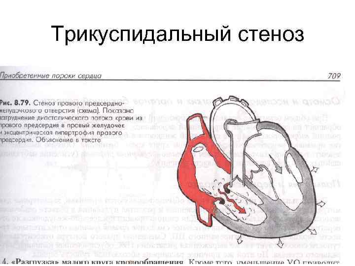 Трикуспидальная недостаточность презентация