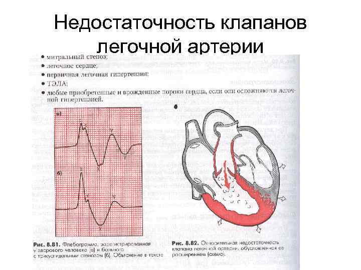 Недостаточность трехстворчатого клапана рисунок