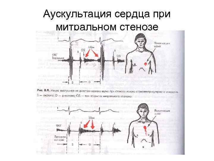 Какие симптомы характерны для аускультативной картины недостаточности митрального клапана тест