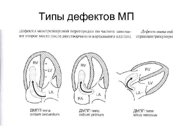 Типы дефектов МП 