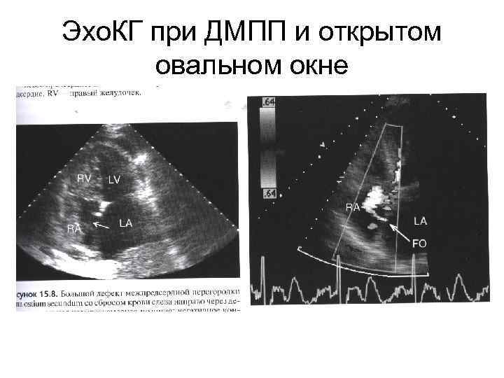 Эхо. КГ при ДМПП и открытом овальном окне 