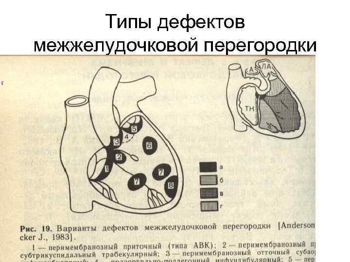 Типы дефектов межжелудочковой перегородки 