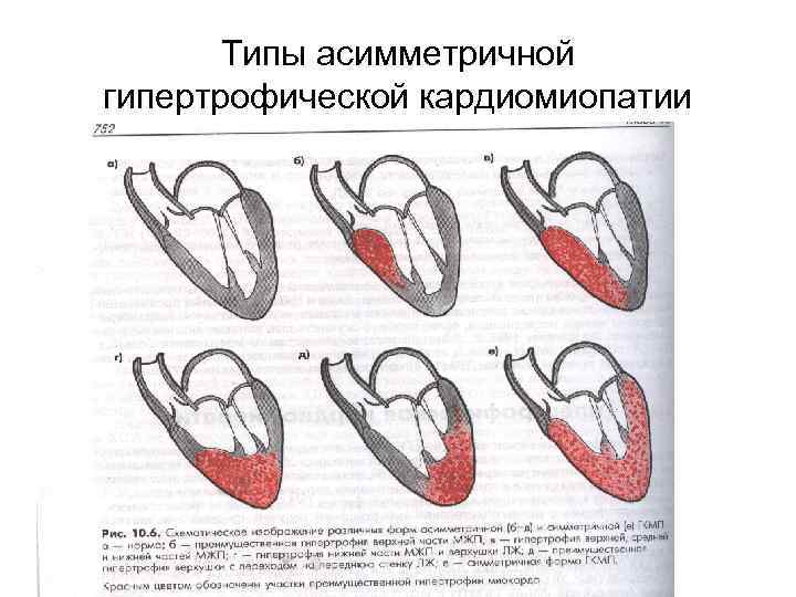 Типы асимметричной гипертрофической кардиомиопатии 