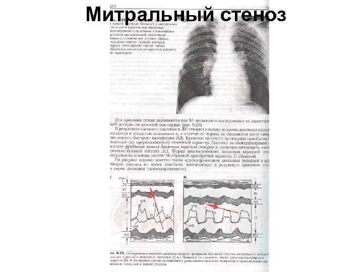 Митральный стеноз 