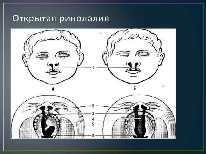 Открытая ринолалия 